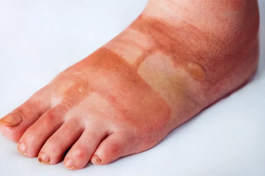 Foot Eczema Treatment