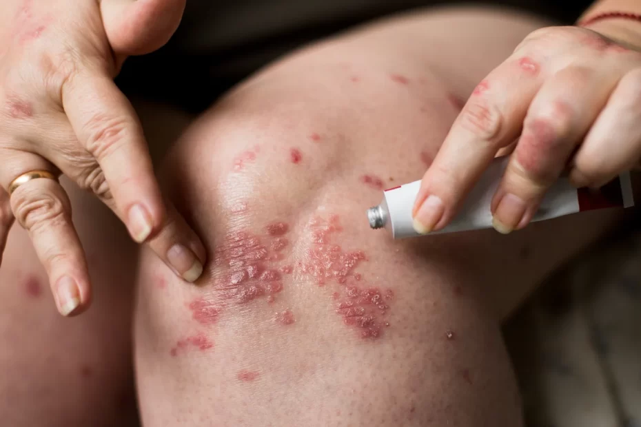 How To Treat Eczema