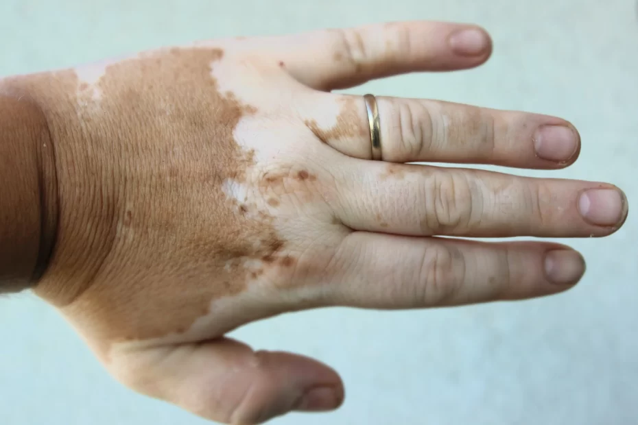 Vitiligo BeFore And After