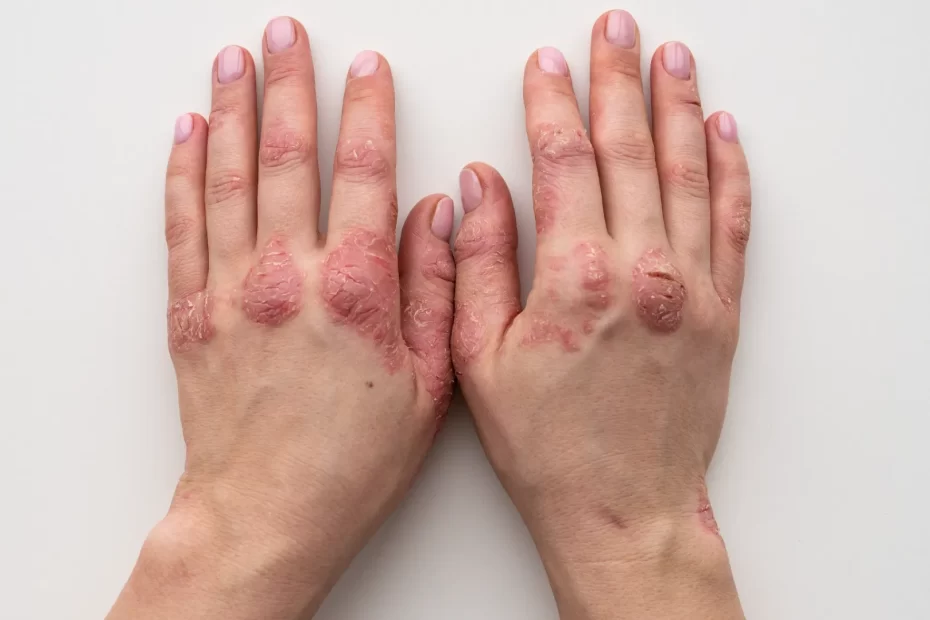 4 MOnth Old Eczema