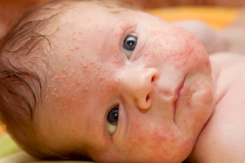 Baby Eczema Natural Treatment