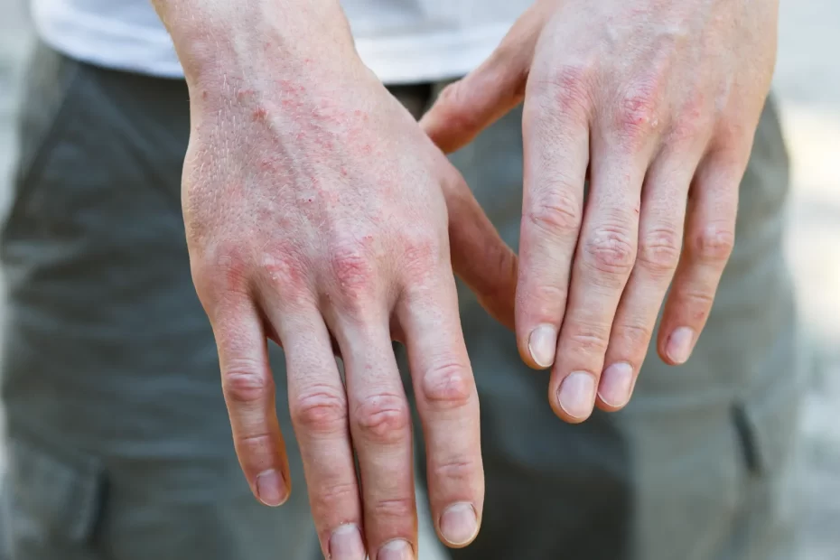 Eczema Causes