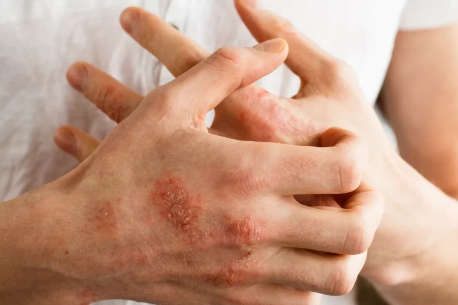 Eczema Treatment At Home Remedies