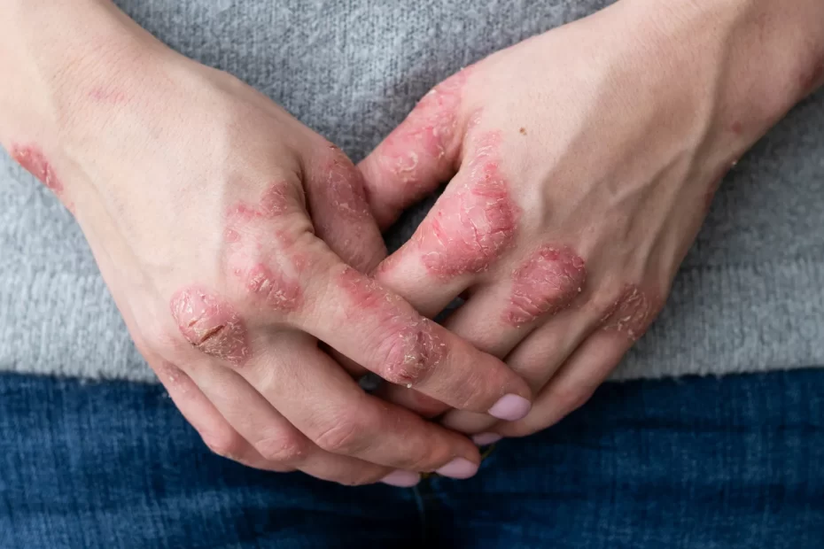 Eczema Under Arm