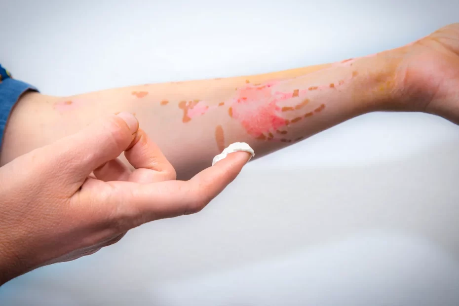 Eczema Vs Seborrheic Dermatitİs