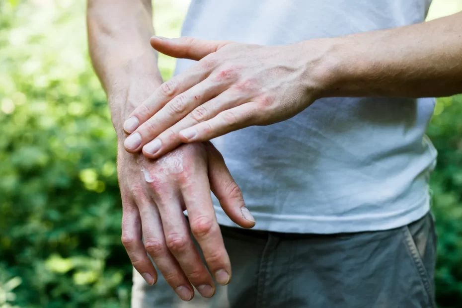 Finger Eczema home Treatment