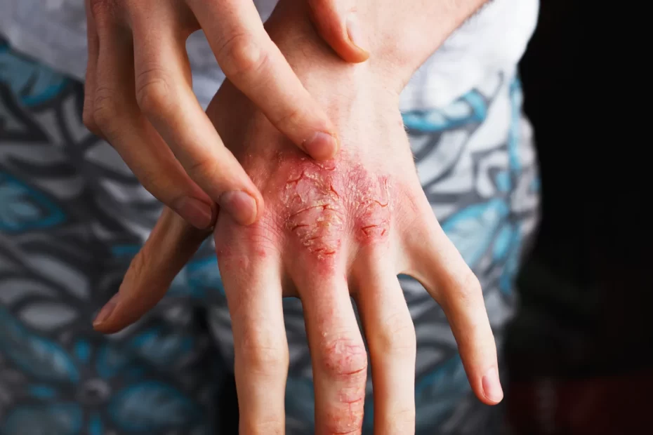 Tsw Eczema